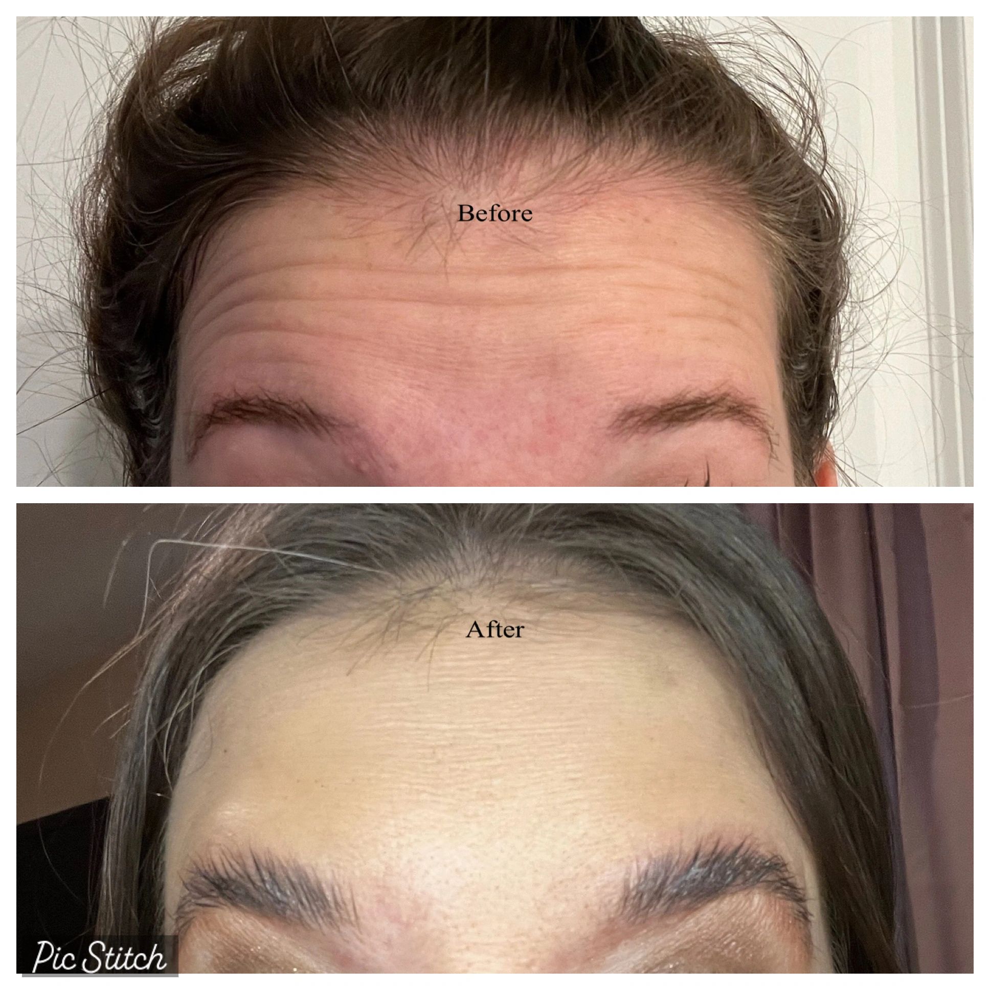 BEFORE AND AFTER PHOTOS OF BOTOX TREATMENT IN ROCKWALL TEXAS