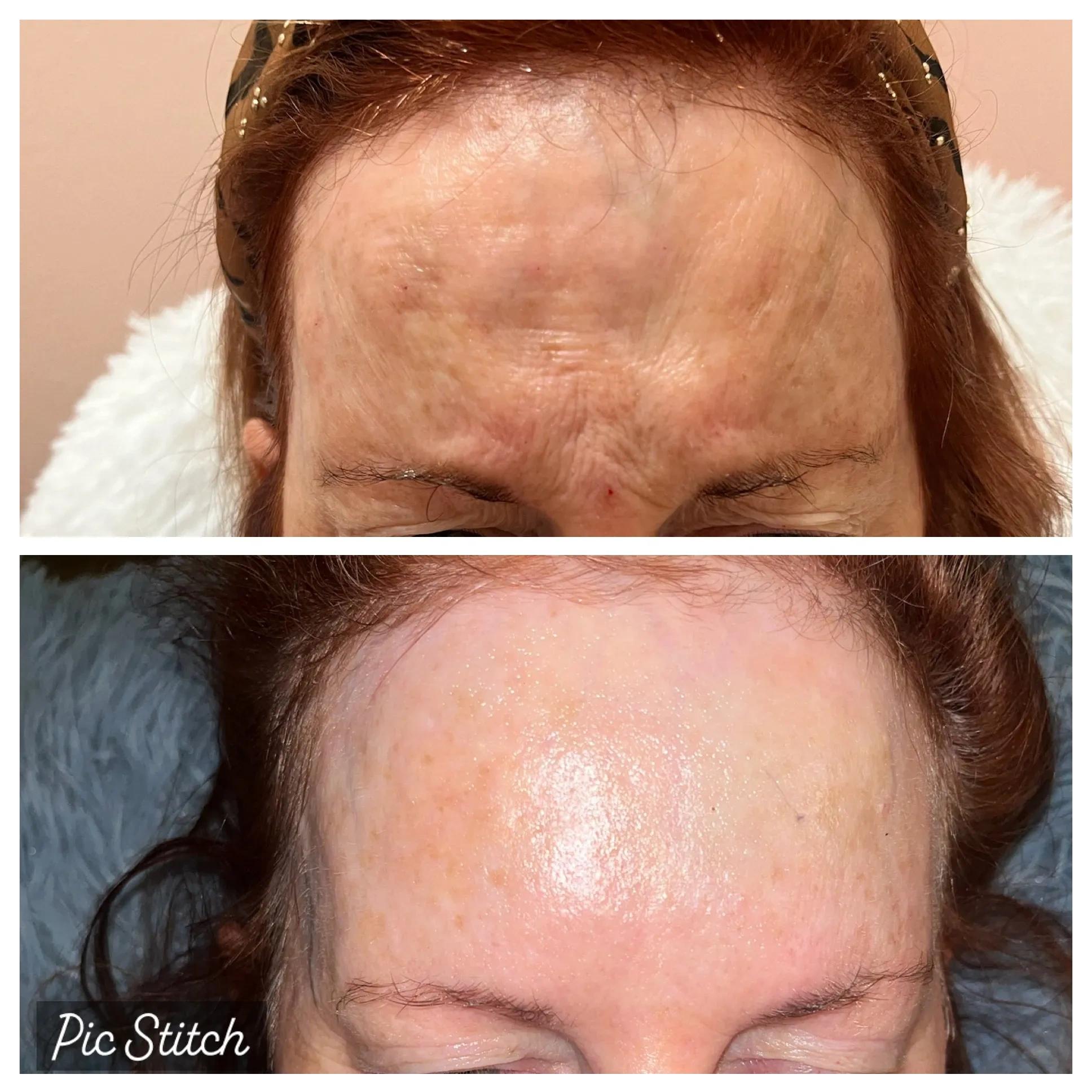 BEFORE AND AFTER PHOTOS OF BOTOX TREATMENT IN ROCKWALL TEXAS