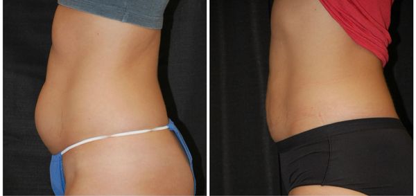 before and after liposuction abdomen