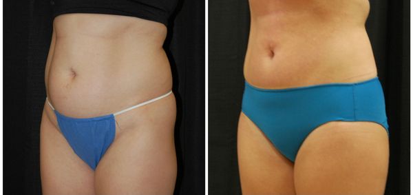Before and after liposuction abdomen