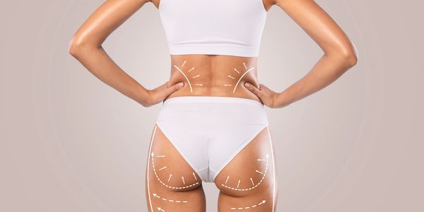 Liposuction Flanks Hips