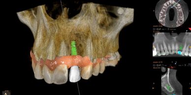 Implantes Dentales unitarios o multiples 
Dr. Grisolia - Dentistas Guatemala 
Implantes Dentales