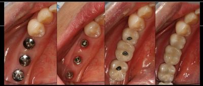 Dr Luis Grisolia 
Implantes Dentales Guatemala 
Dentistas Guatemala 
Clinica Dental 
Carillas dental