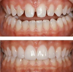 Carillas Dentales 
Denti Vitale
Luis Grisolia 
Dentista
Dentistas Guatemala 
Diseño de Sonrisa