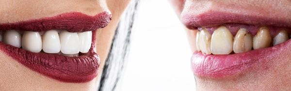 Diseño de Sonrisa 
Dr. Luis Grisolia 
Dentistas Guatemala 
Best Dentist