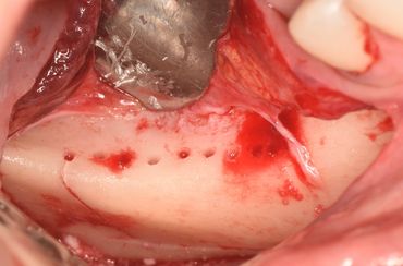 Close-up of dental bone with perforations and surrounding soft tissue during surgery.