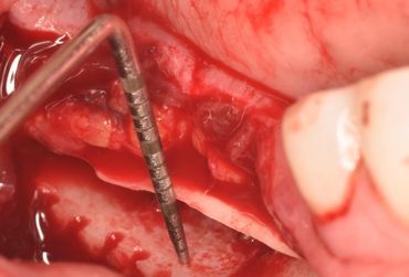 Close-up of a dental surgical site with a periodontal probe measuring bone levels.
