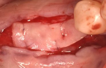 Close-up of oral surgery with sutures in gums near a molar tooth.