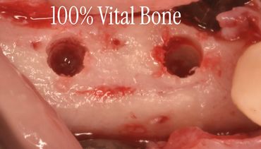 Close-up of two drilled holes in vital bone tissue during surgery.