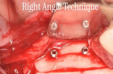 Surgical dental bone graft secured with screws using right angle technique.