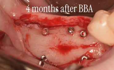 Oral surgery site with implants four months post-BBA procedure.