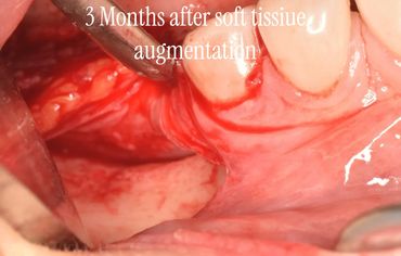 Oral cavity three months after soft tissue augmentation showing healed tissue.