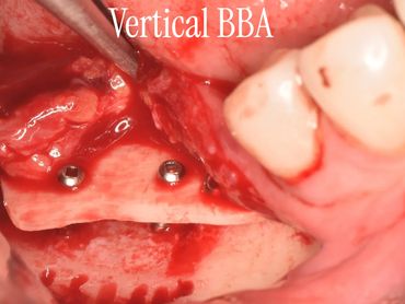 Close-up of a dental surgery showing vertical block bone augmentation with implants.