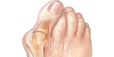 Bunion, hallux valgus, hallux abductovalgus