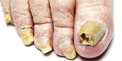 Onychomycosis, fungal toenails
