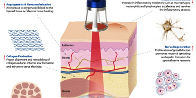 Lightforce, high power, hot laser, photobiomudulation.