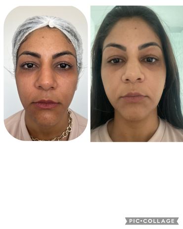 Resultado de paciente tratado com bioestimuladores de colágeno.