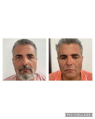 Resultado de paciente tratado com bioestimuladores de colágeno.