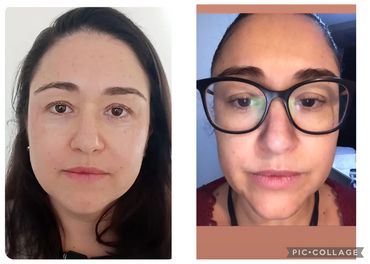 Resultado de paciente tratado com bioestimuladores de colágeno.