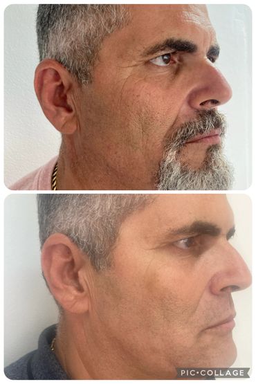 Resultado de paciente tratado com bioestimuladores de colágeno.