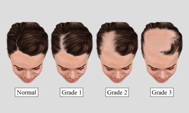 Four stages of female hair thinning arranged from normal to grade 3.