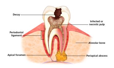 Diagram of an infected tooth with labeled parts.
