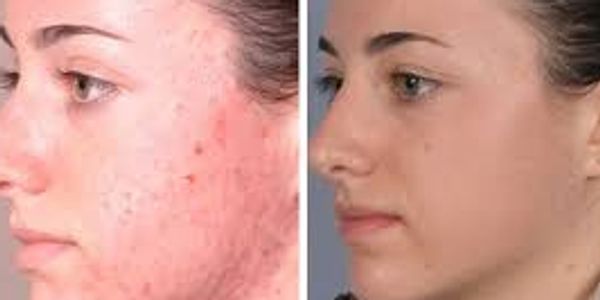 Microdermabrasion is a minimally invasive procedure used to renew overall skin tone and texture. It