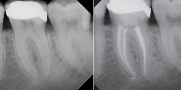 endodontiste liege, endodontiste saint nicolas