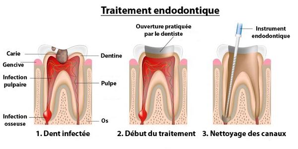endodontiste liege, endodontiste saint nicolas
