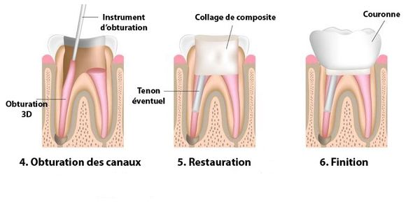 endodontiste liege, endodontiste saint nicolas