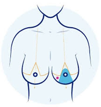 Illustration of breast lift surgery with markings.