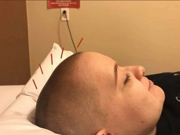 Woman with acupuncture needles in her head.