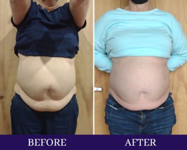Abdominal fat before and after cryotherapy