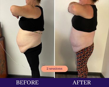 Before and after fat loss cryosculpting woman