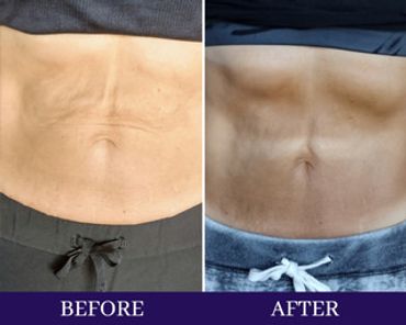 Before and after cryotherapy - male abdomen