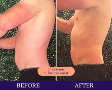 Male before and after cryosculpting pic