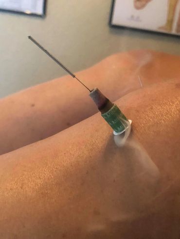 Moxa cone on a needle with smoke curing around it.