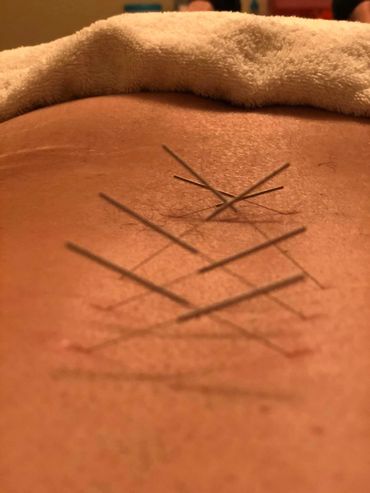 Crossed acupuncture needles in a man's back.