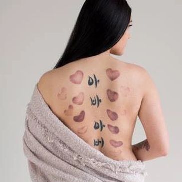 Heart-shaped Fire Cupping Marks