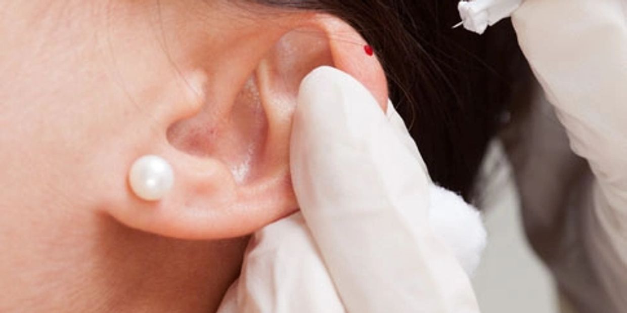 Therapeutic blood draw an on-ear to reduce pain.