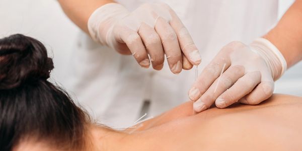 A woman's back is being treated with acupuncture.