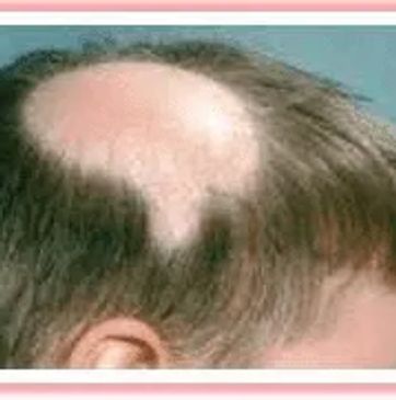 male alopecia