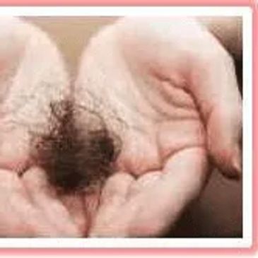 lost hair from alopecia