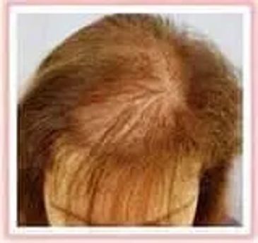 alopecia on a woman