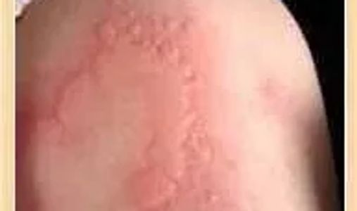 Drug Allergic reaction picture