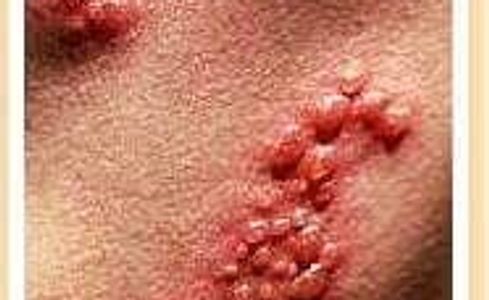 picture of herpes breakout
