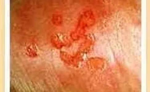 herpes rash picture
