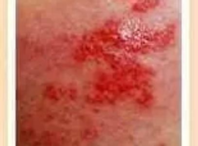 herpes rash