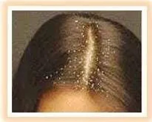 lice on head