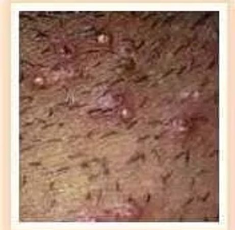 molluscum Contagiosum Example